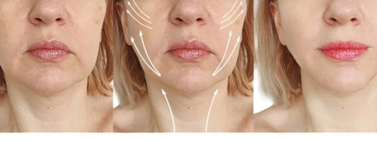 Efecto tensor facial del tratamiento INDIBA mediante radiofrecuencia